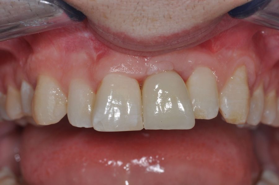Single tooth implants - after - 3Dental